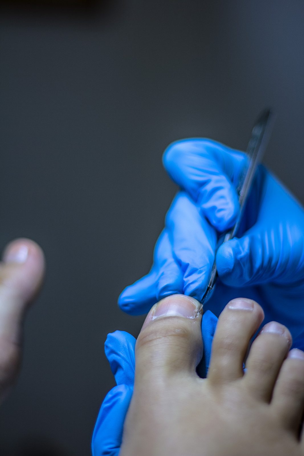 Podiatrist assessing an ingrown toenail at Berkshire Podiatry in Reading